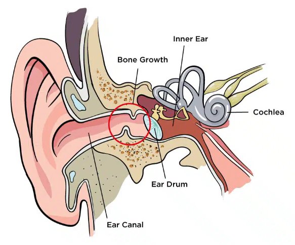 SURFER’S EAR Understanding the Risks and How to Avoid Them - Worthing Watersports